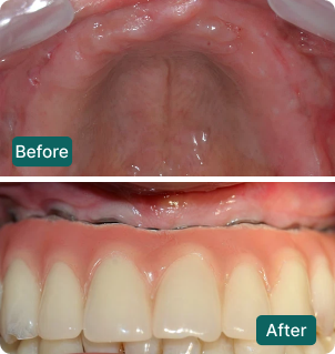 Before and after: Full upper arch restoration