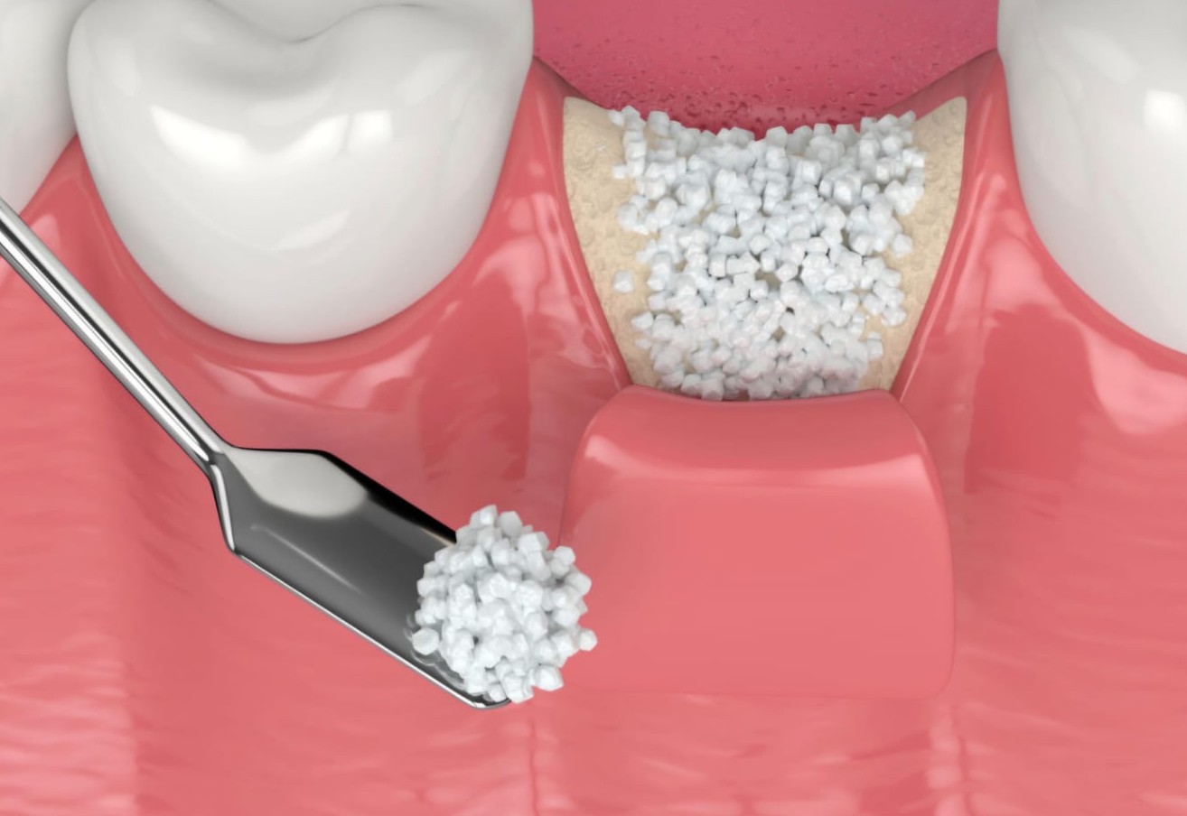 Synthetic bone grafting of alveolar defect illustration
