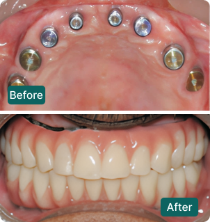Before and after: Multi implant full arch