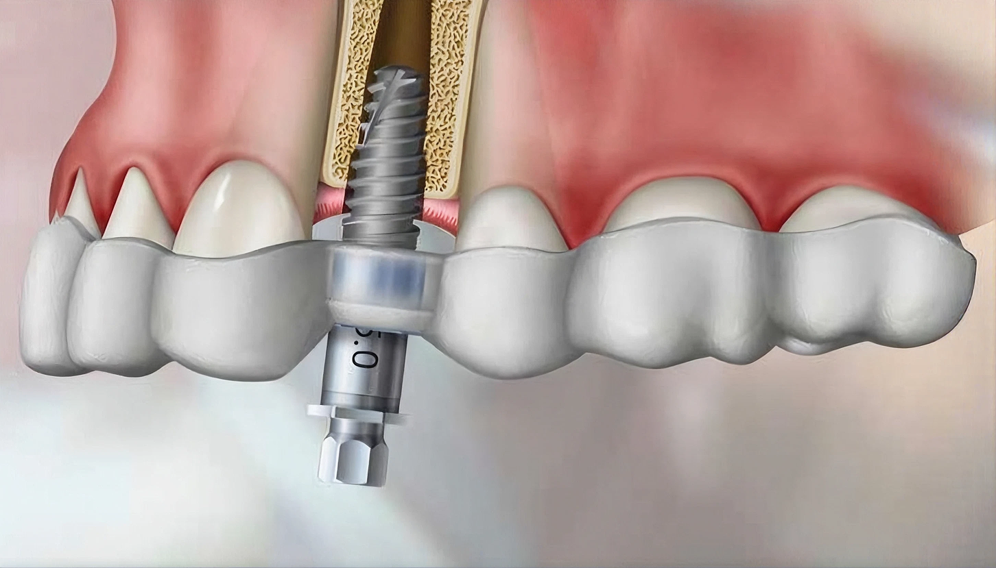Single implant guided surgery illustration