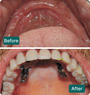 Before and after: Upper arch fixed bridge