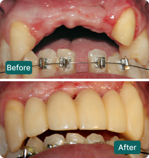 Before and after: Anterior bridge rehabilitation