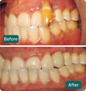 Before and after: Aesthetic smile correction
