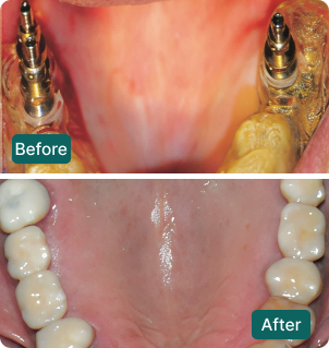 Before and after: Lower arch reconstruction